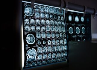 Czy rezonans magnetyczny wykryje nerwicę?